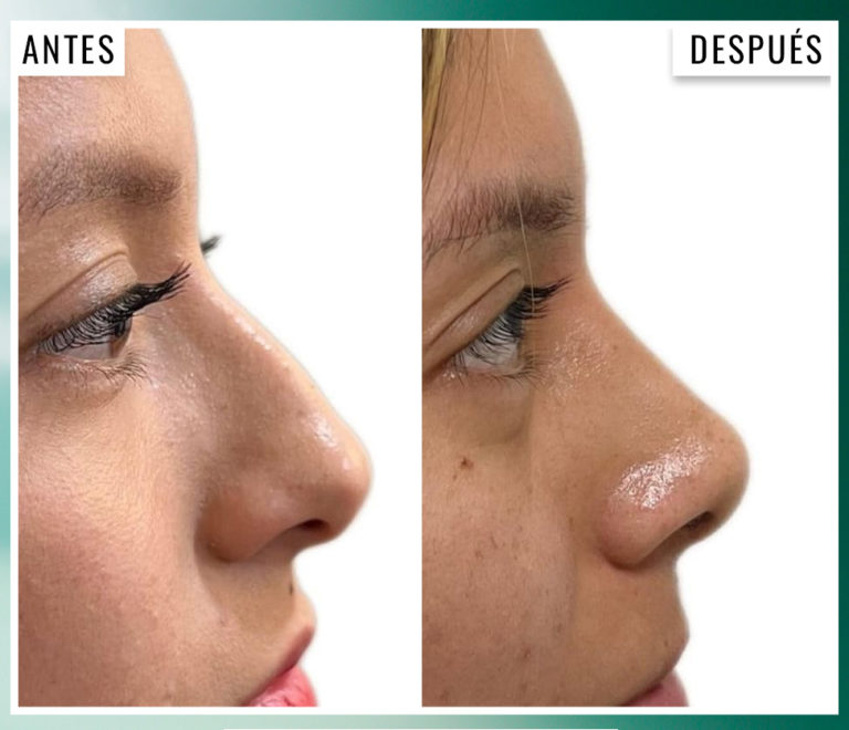 ayd-rinoplastia-5
