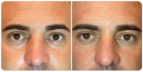 ayd-ojeras-1