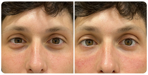 ayd-ojeras-2